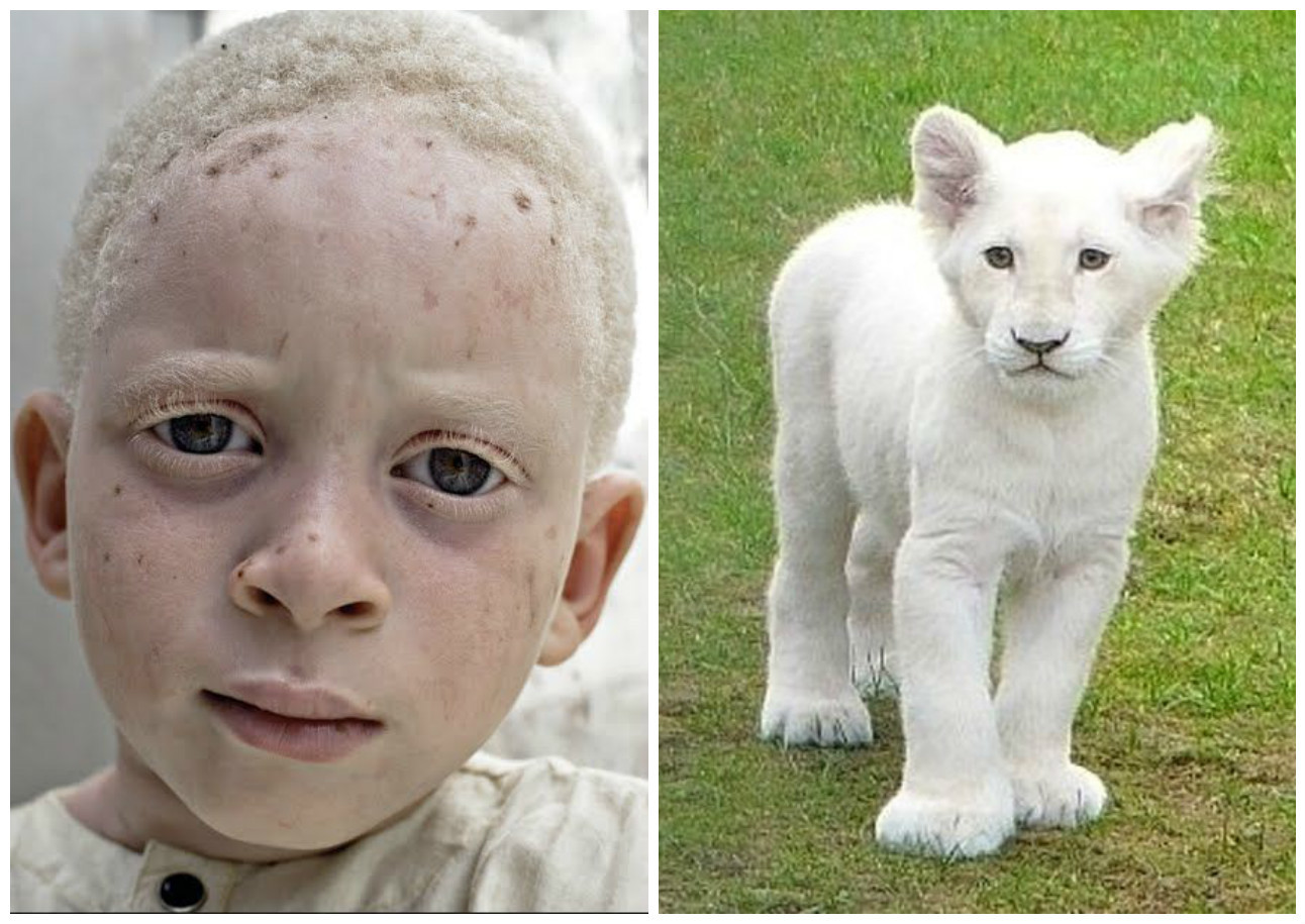 Наследственные болезни альбинизм