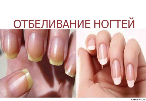 Чем отбелить кончик ногтя Чем отбелить кончик ногтя