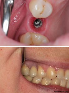 Импланты зубов – преимущества и недостатки