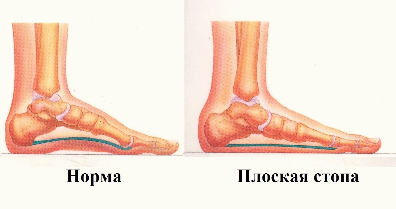 Плоская стопа картинки