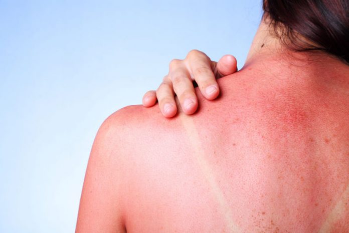 Почему кожа чешется и горит после солнечных ванн? Как это облегчить?