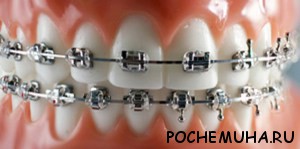 Металлические брекеты
