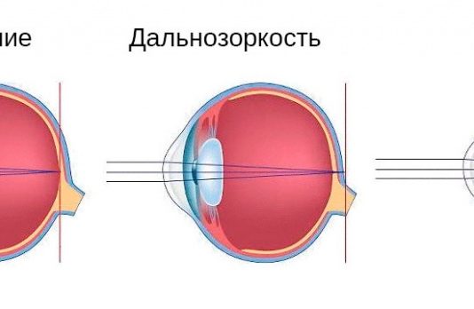 Как восстановить зрение
