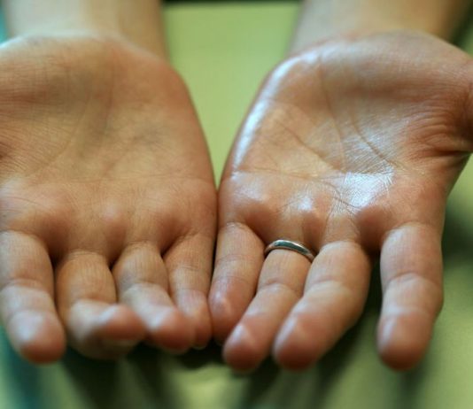 Почему потеют ладони рук?