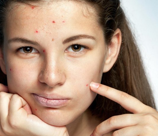 Почему появляются ювенильные угри? Почему появляются ювенильные угри?